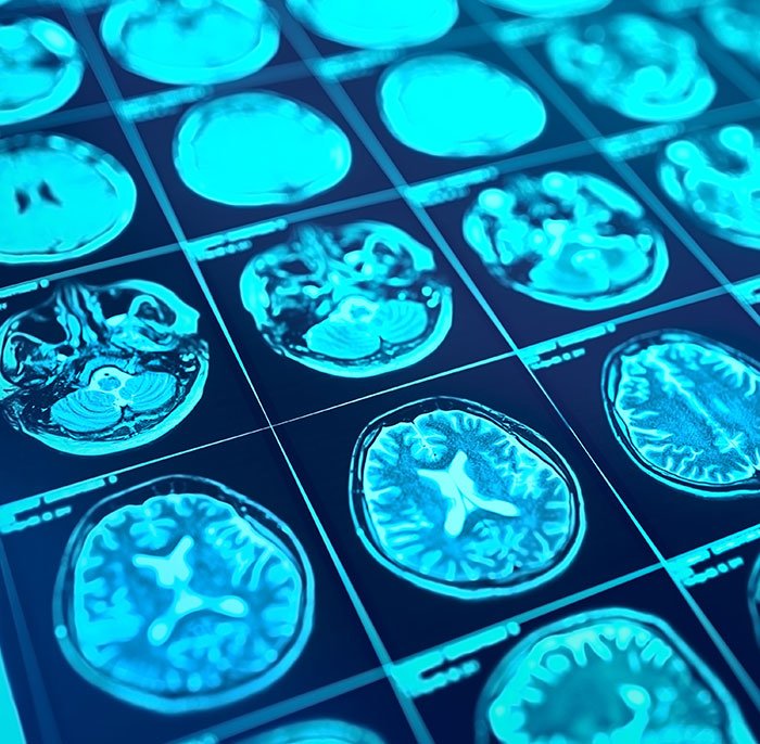 Brain scan images showing detailed cross-sections highlighting areas of low brain activity in a medical context.