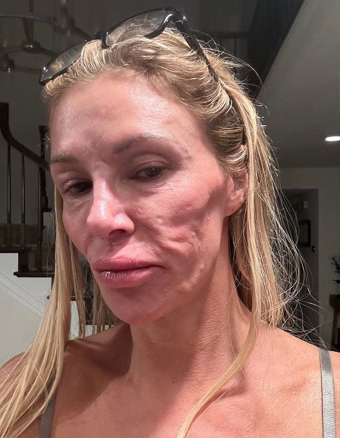 Brandi Glanville close-up showing face disfigurement after diagnosis with natural lighting indoors