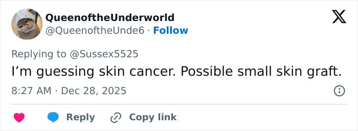 Tweet discussing a possible skin cancer scar and small skin graft in reference to Kate Middleton’s appearance.