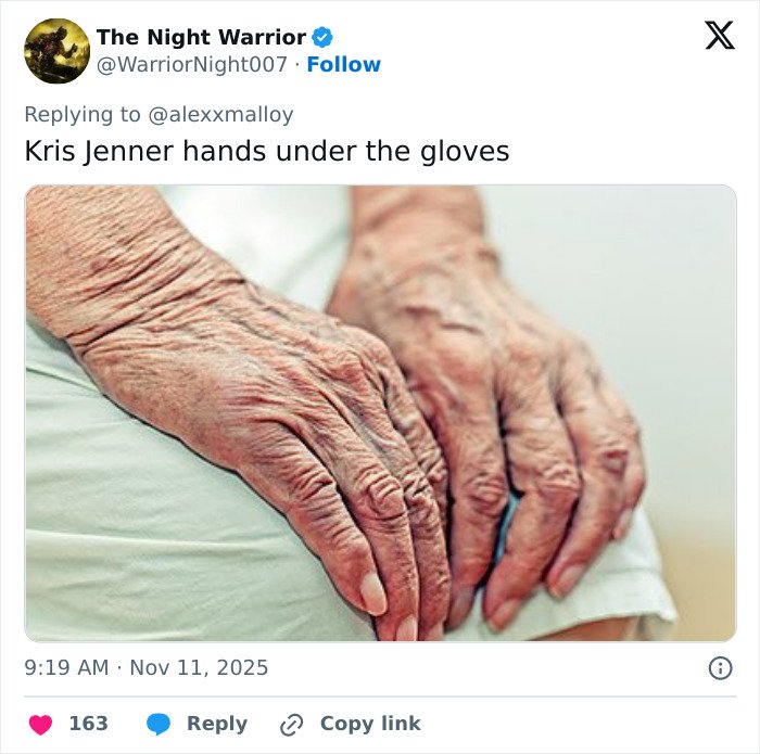 A close-up of aging hands showing wrinkles and veins, highlighting hands after viral $100k facelift reveal.