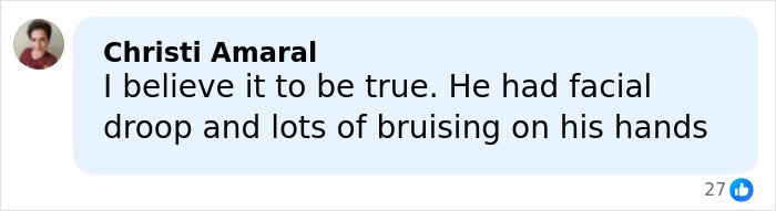 User comment mentioning facial droop and bruising on hands in a discussion about Trump’s health speculation concerns.