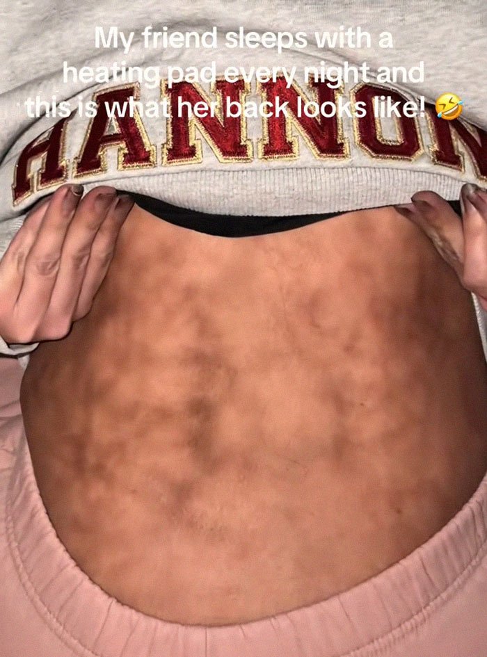 Close-up of a woman’s back showing toasted skin syndrome after using a heating pad regularly.