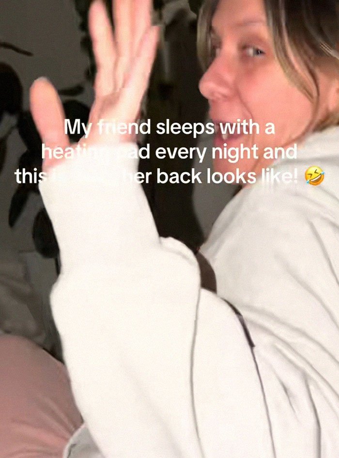 Woman showing skin condition caused by heating pad use, illustrating toasted skin syndrome on her back.