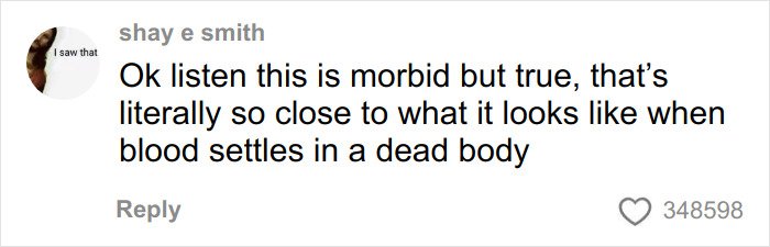 Comment about blood settling in a dead body, reflecting on the appearance linked to toasted skin syndrome.