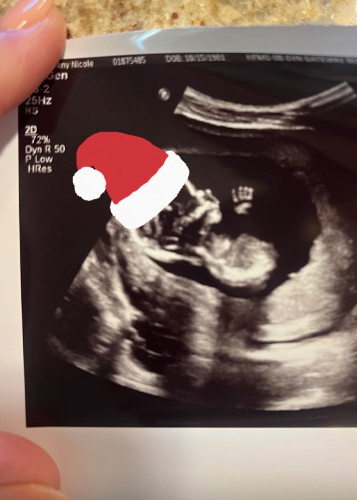 Ultrasound image of a fetus with a digitally added Santa hat, related to fertility clinic mix-up lawsuit.