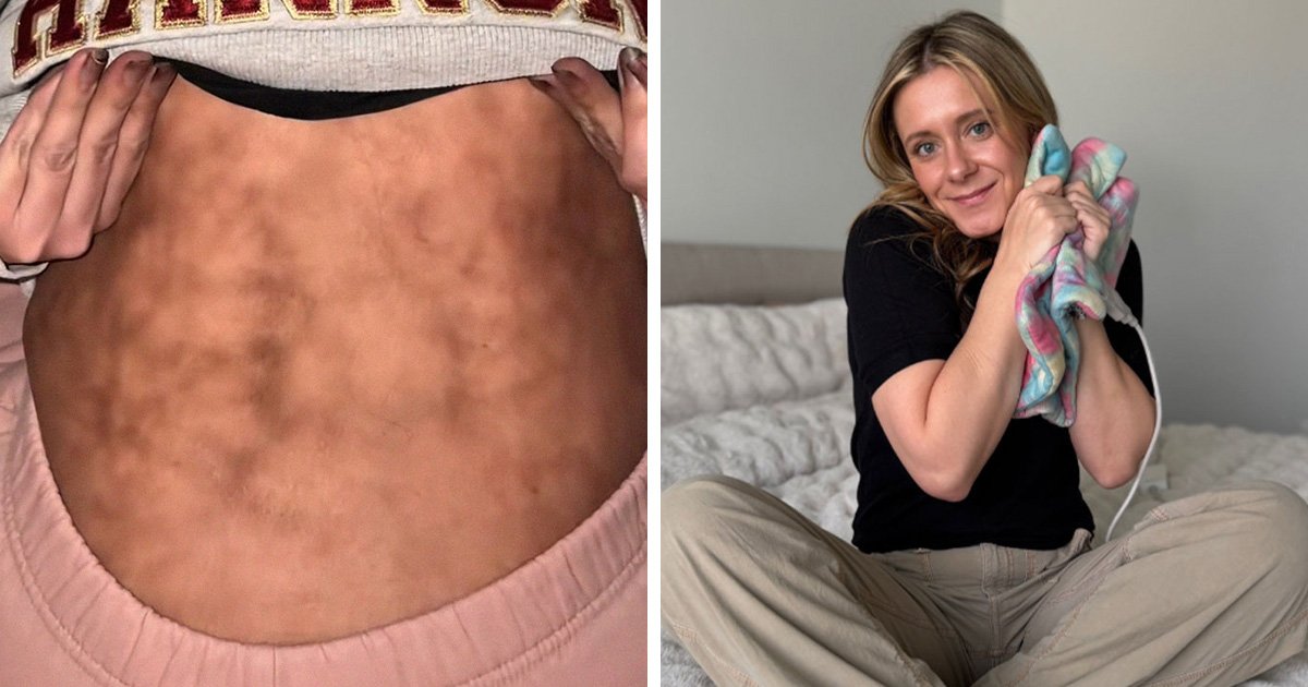 Woman’s Video Goes Viral After She Shows How Her Body Looks After Using A Heating Pad: “Toasted Skin Syndrome”