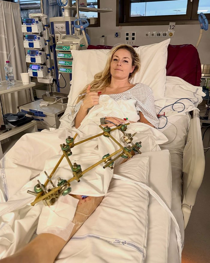 Lindsey Vonn in hospital bed after fifth surgery on broken leg, giving thumbs up despite injury and medical equipment.