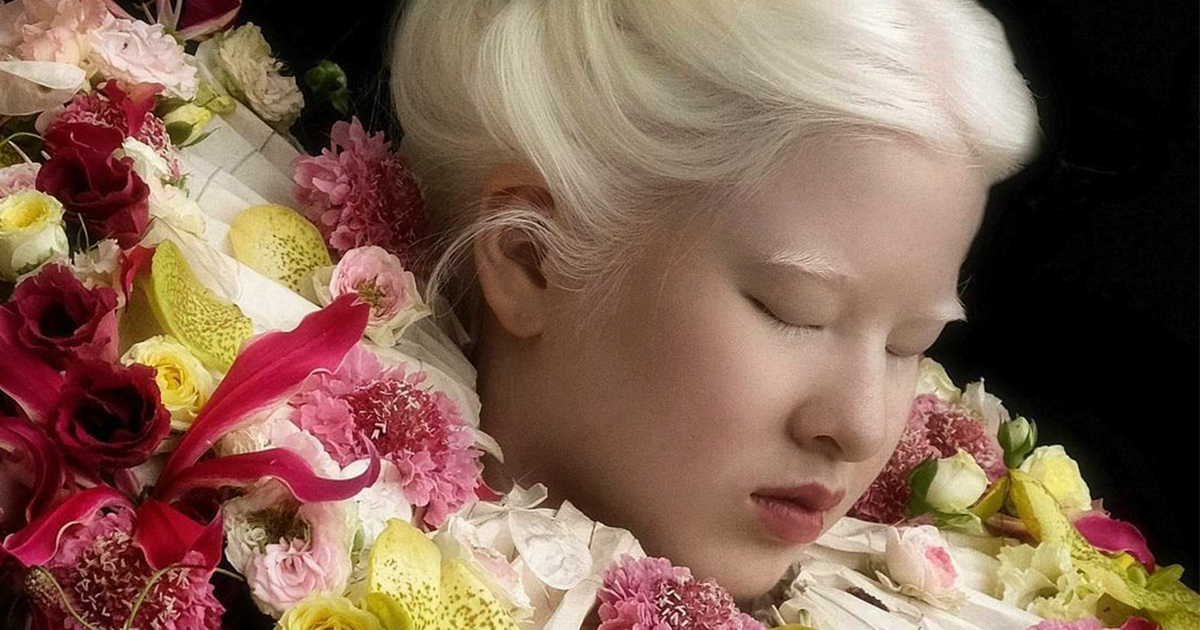 Abandoned As A Baby Due To Albinism, Xueli Grew Up To Become A Vogue Model (25 Pics)